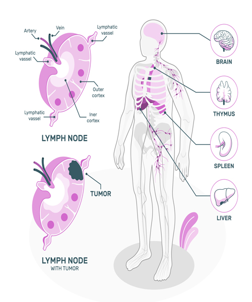 Best Lymphoma Treatment in India 